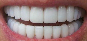 Dentatura perfetta! Un alleato di salute e benessere