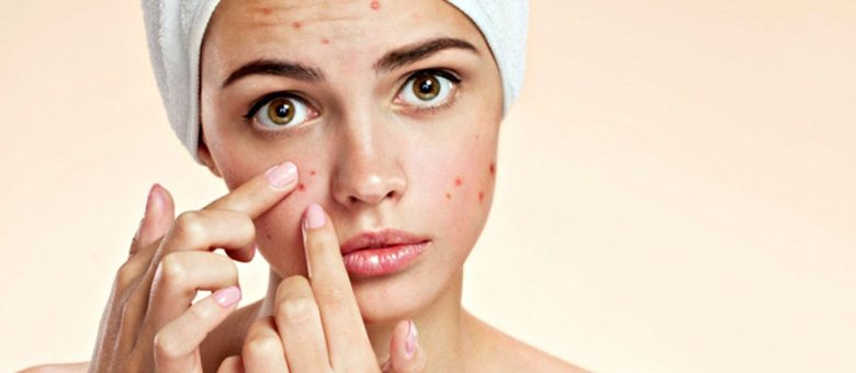 L’acne, può non essere più un vostro problema!