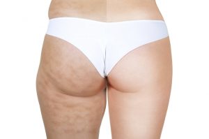 combattere cellulite torino