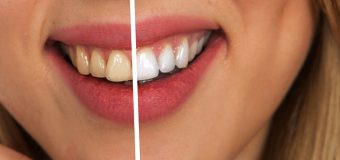 Un sorriso da star con denti luminosi; i rimedi naturali