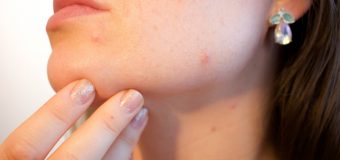 Come curare l’acne