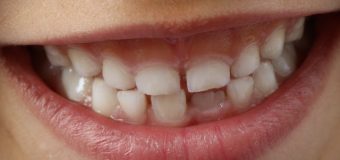 Bambini e caduta primi denti: i consigli di Dental World Clinic