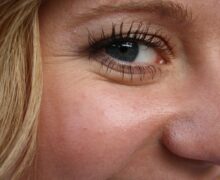 Ringiovanire lo sguardo con la blefaroplastica: Dr Massimo Maida