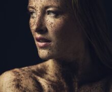 Dermatite Atopica: Come prendersi cura della pelle sensibile