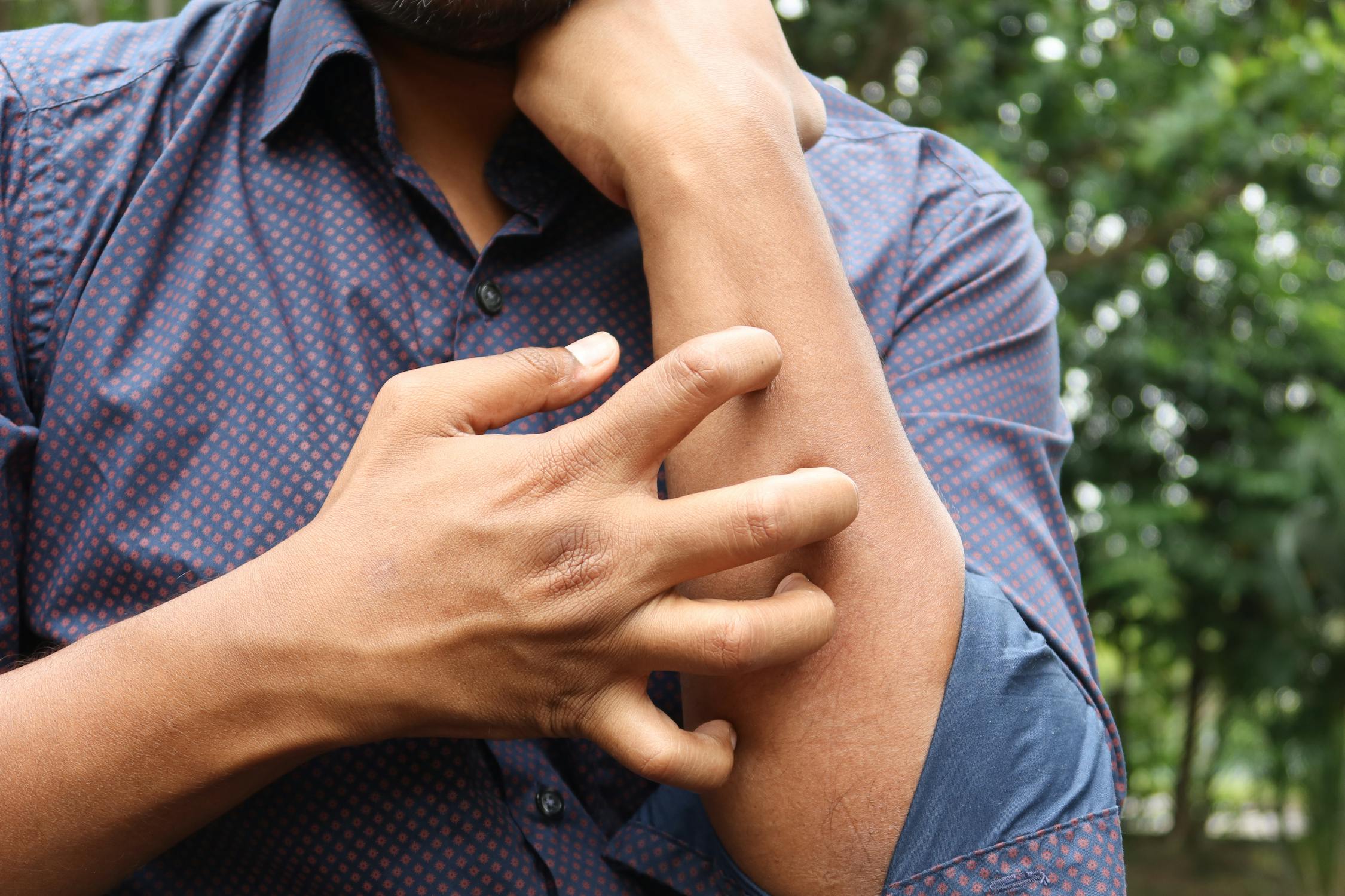 Dermatite Atopica: Come prendersi cura della pelle sensibile